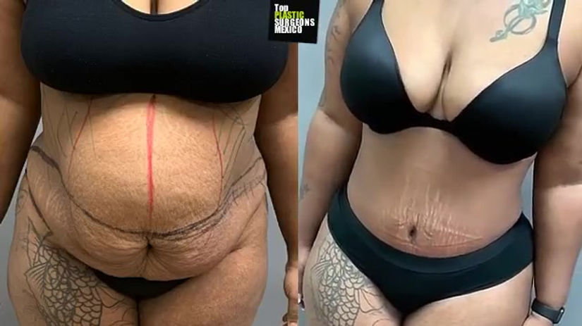 TUMMY TUCK + 360°LIPO
